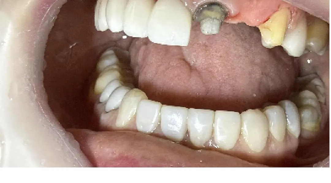 Before: worn and missing teeth