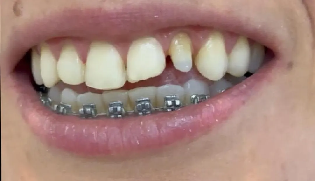 Before: tooth chipped in an accident