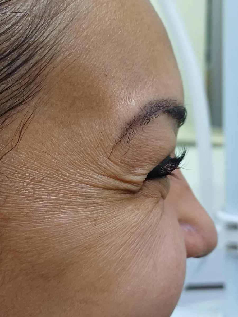 Before: crow's feet