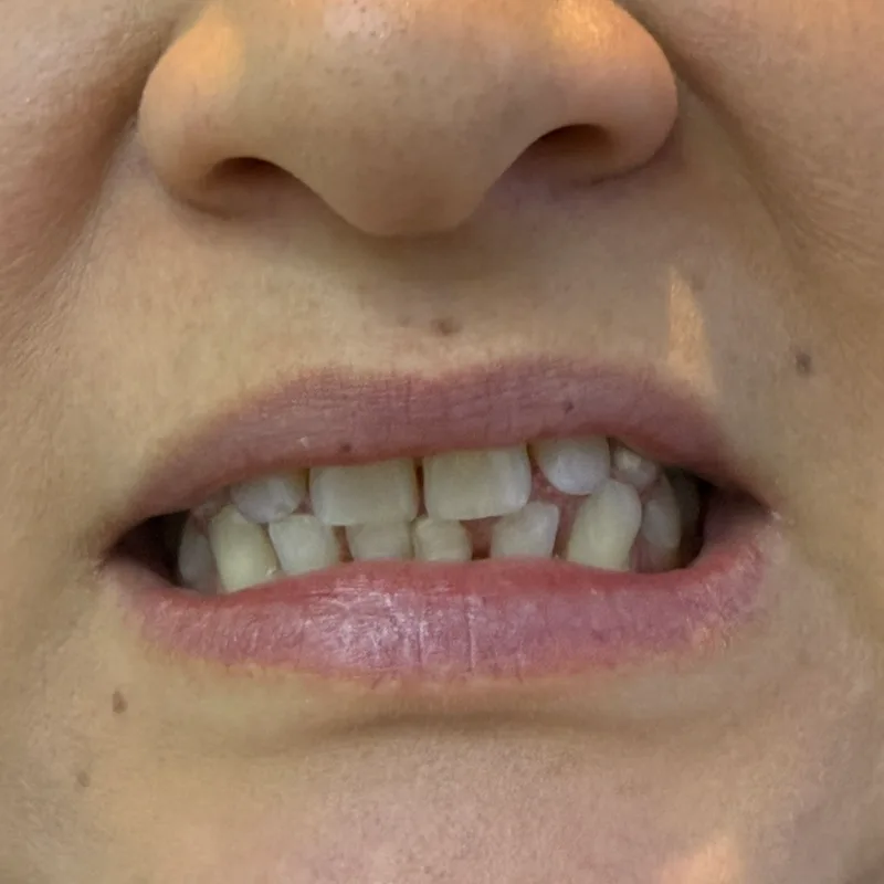 Before: crowded, uneven teeth