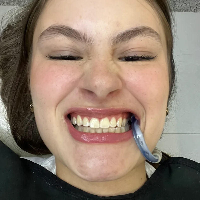 Before: yellowish teeth