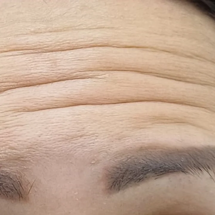 Before: deep forehead lines