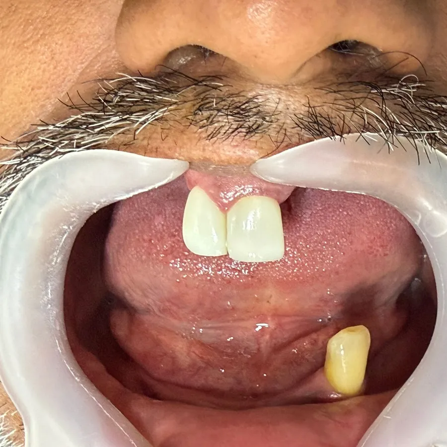 Before: Carlos had lost almost all his teeth