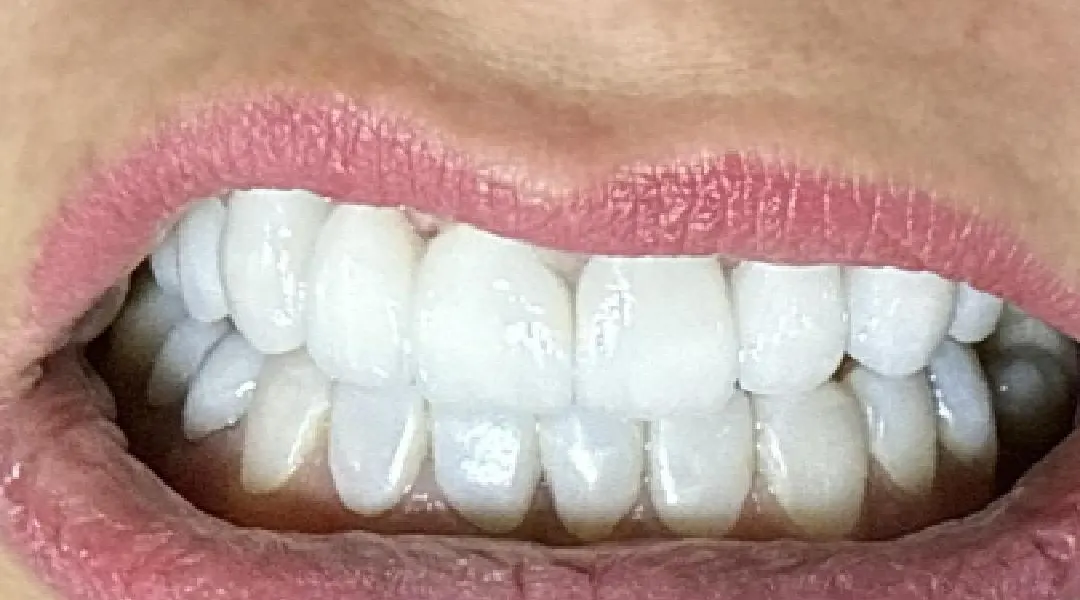 After: a restored smile
