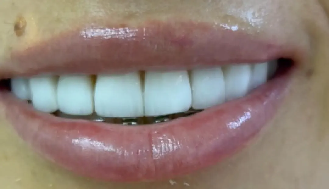 After: ceramic veneers