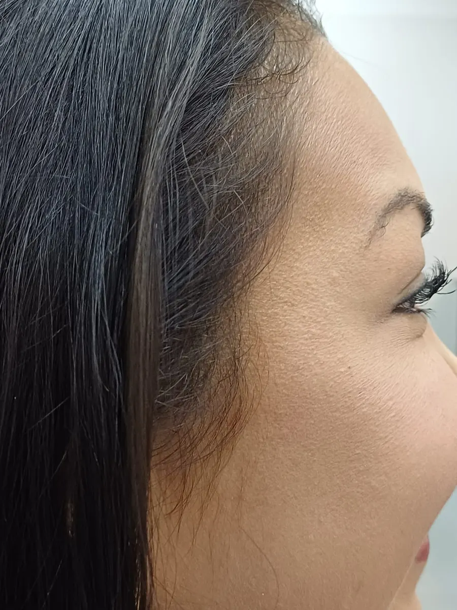 After: facial harmonization