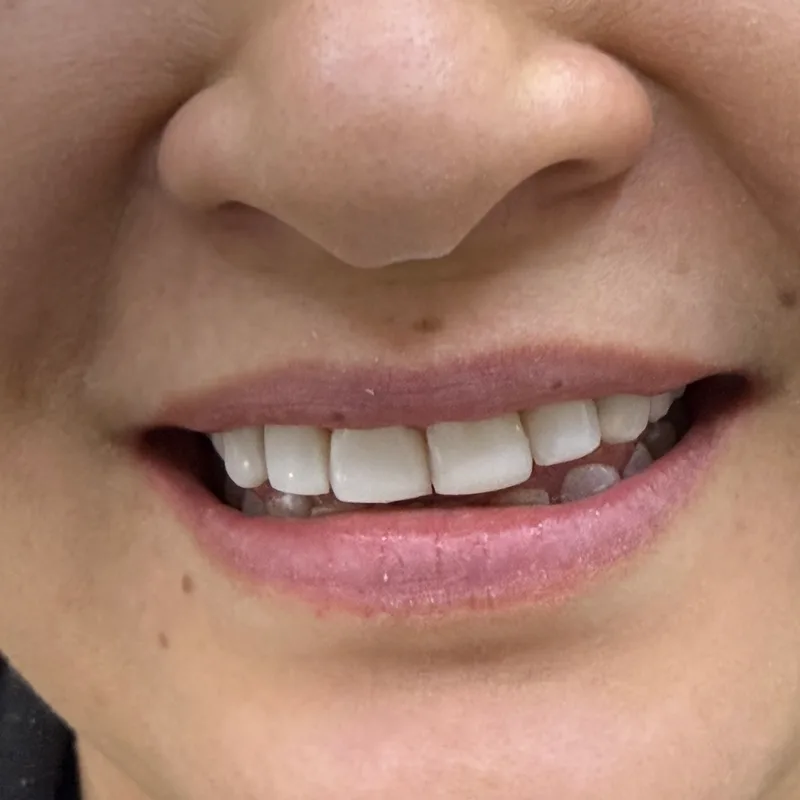 After: an aligned, harmonious smile