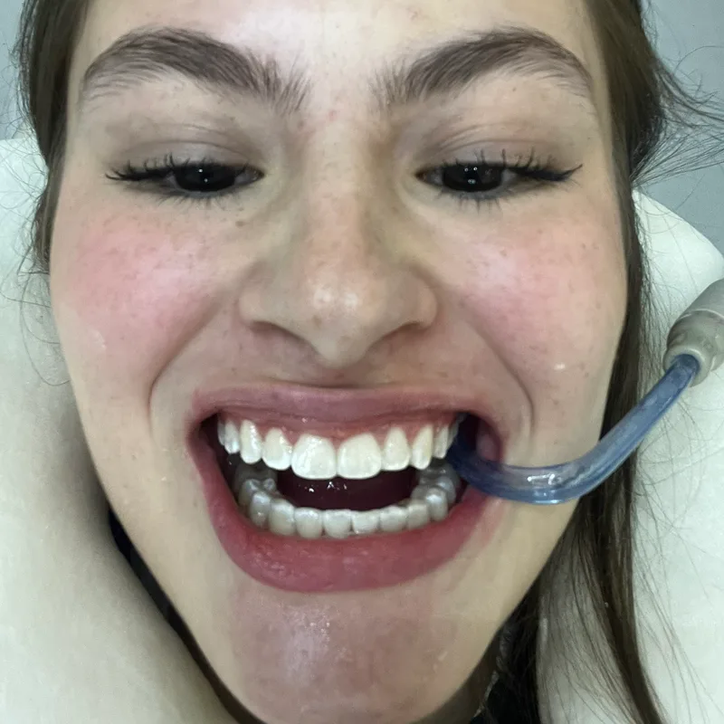 After: a whiter, more even smile