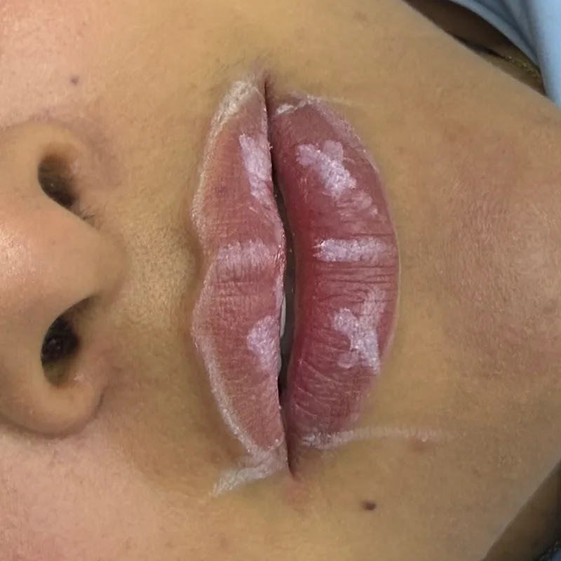 After: lips with hyaluronic acid