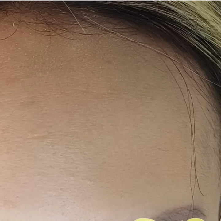 After: smooth forehead with botulinum toxin