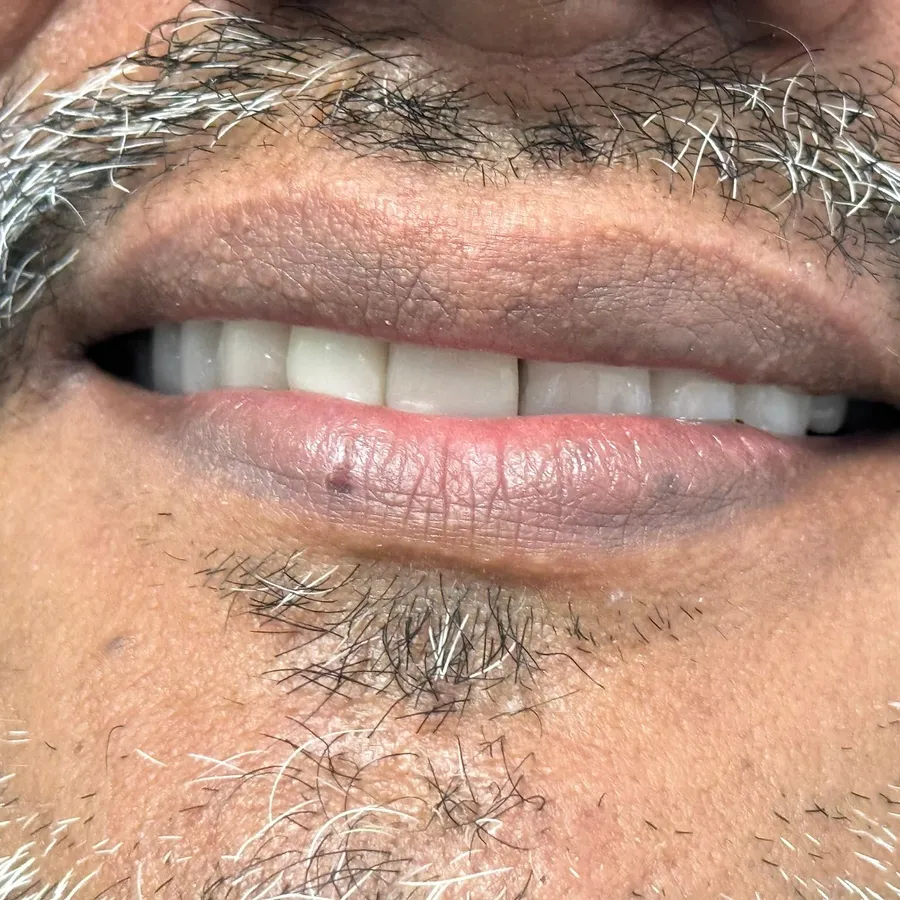 After: Carlos with upper and lower dentures