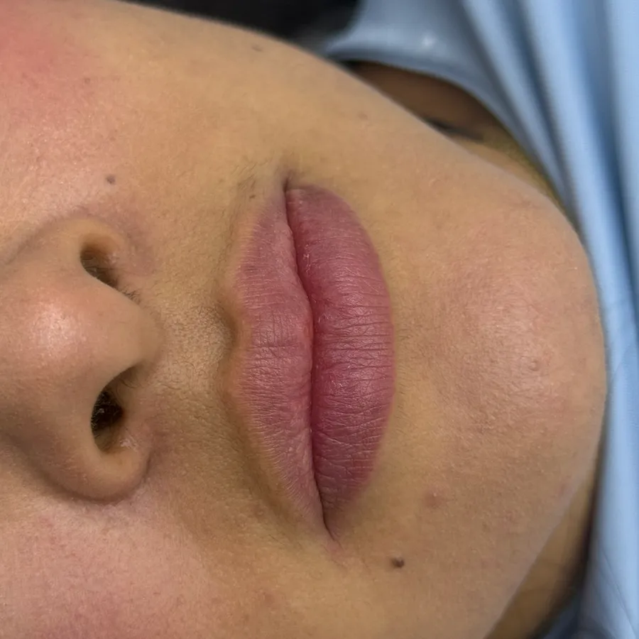 Labios tratados con ácido hialurónico