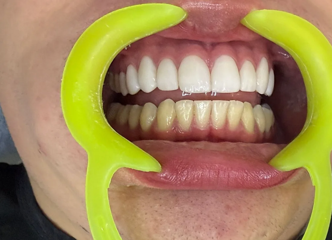 Real comparison: veneers on the upper teeth next to the natural lower teeth
